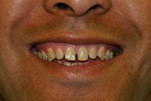 Porcelain Veneers and Crowns