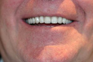 Implant Supported Dentures