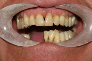 Implant Supported Dentures