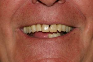 Implant Supported Dentures