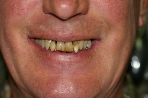 Implant Supported Dentures