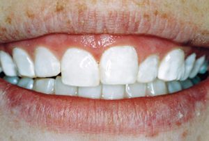 Patient's teeth after veneer