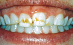 Patient's teeth before veneer