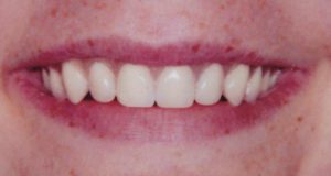 Patient's teeth after restoration