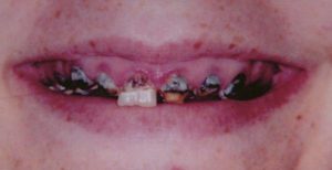 Patient's teeth before dentures