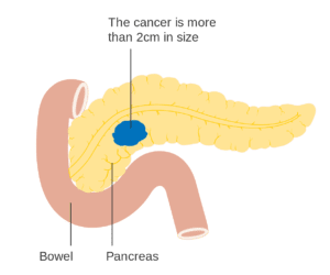 pancreatic-cancer-gum-disease