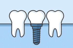 dental implants