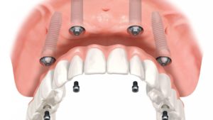 All on four implant supported dentures