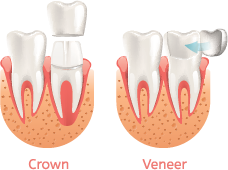 dental crowns