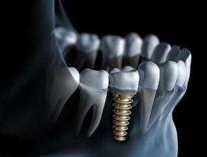 dental implants questions