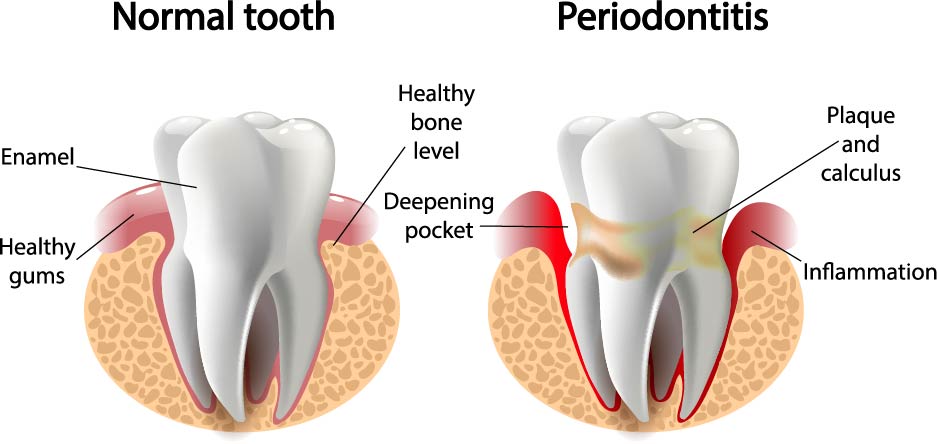 periodontitis