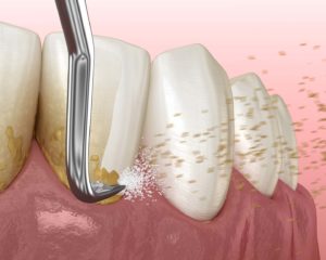 dental scaling