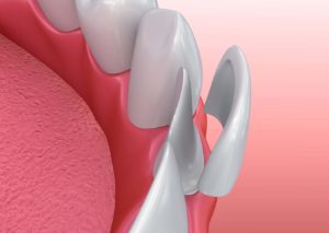 Dental Veneers graphic